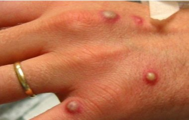  Bahia registra cinco novos casos de Monkeypox